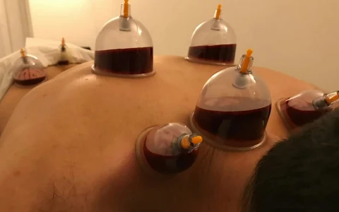 Hijama Therapy Cupping Clinic image