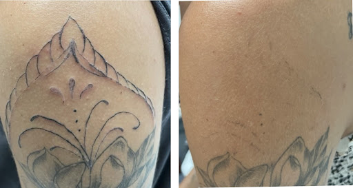 Find is a hand tattoo a bad idea for your next unique tattoo in San Antonio at MEDermis Tattoo Removal