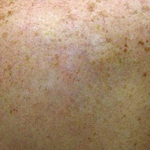 Explore scissor tattoo ideas, creative tattoo ideas in Weatherford, available at Vanish Laser Tattoo Removal and Skin Aesthetics