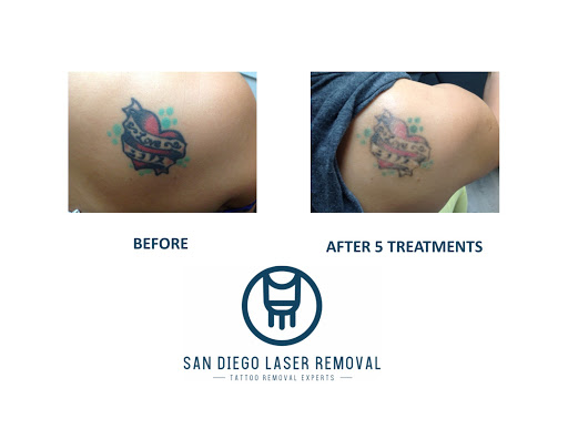Explore rn tattoo ideas, creative tattoo ideas in San Diego, available at Removery Tattoo Removal & Fading