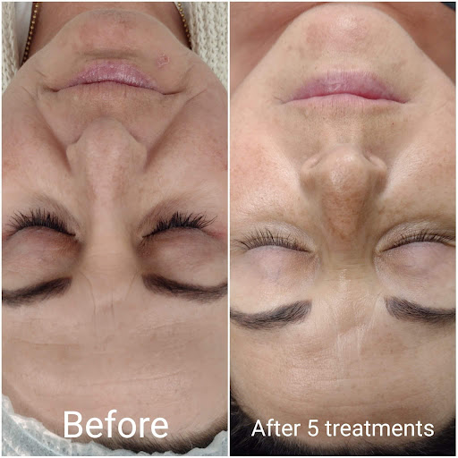 Explore electricity tattoo ideas, creative tattoo ideas in Brighton, available at Tip of the Spear Laser Esthetics