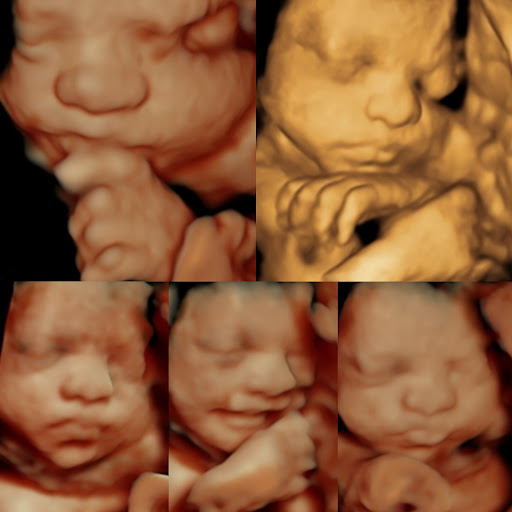 A Little Insight 3D 4D 5D Ultrasound image