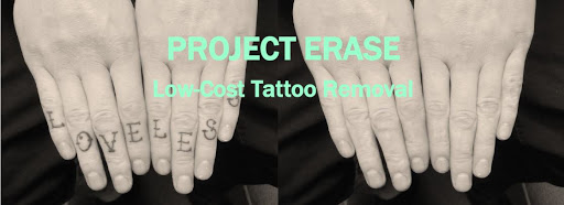 Project Erase Tattoo Removal
