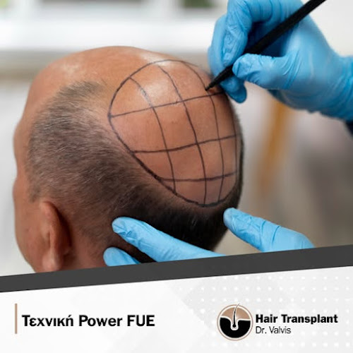 Opinii despre Μεταμόσχευση Μαλλιών & Εμφύτευση Μαλλιών - Δρ. Βάλβης Παντελής - Hair Transplant Dr. Valvis în Πειραιάς - Γιατρός