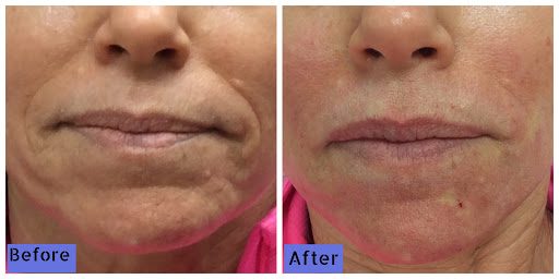 Explore l tattoo ideas, creative tattoo ideas in Lake Oswego, available at Lake Oswego Vein and Aesthetic LOVA