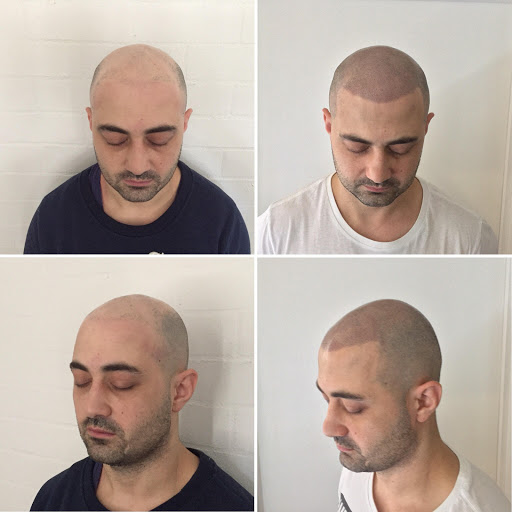 The Look SMP Melbourne, Hair Tattoo Scalp Micropigmentation Melbourne