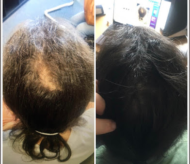 عيادات تساقط الشعر - كارلايل - The Hair Loss Clinics - Carlisle