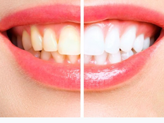 Allure Teeth Whitening