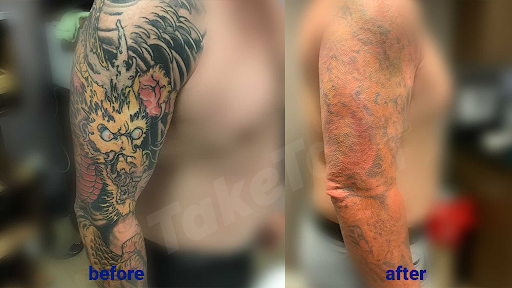 Explore cover up shoulder tattoo ideas, creative tattoo ideas in Sheffield Lake, available at TakeTatt Tattoo Removal