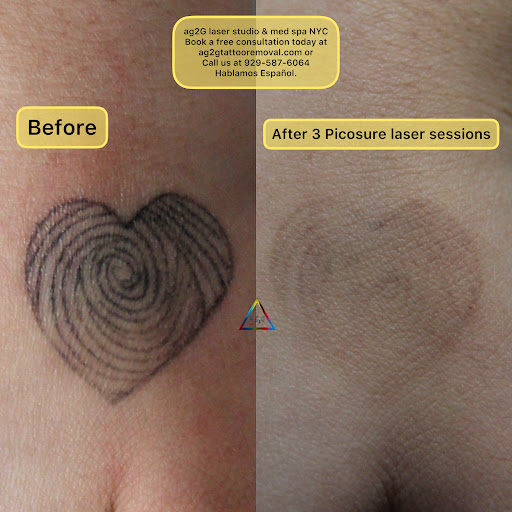 Explore 1111 tattoo ideas, creative tattoo ideas in New York, available at Ag2g Laser Tattoo Removal & MedSpa