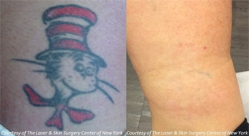 Explore safety pin tattoo ideas, creative tattoo ideas in Southampton, available at Laser & Skin Surgery Center of New York - Southampton