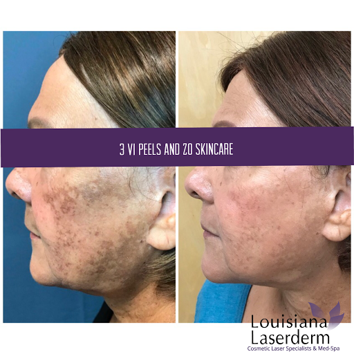 Explore san judas tattoo ideas, creative tattoo ideas in Baton Rouge, available at Louisiana Laserderm