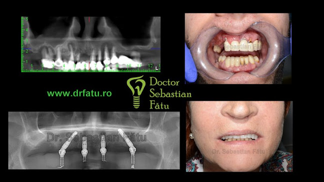 Opinii despre DentaImplant - Implant dentar Bucuresti, Fast&Fixed, implant dentar intr-o zi, Proteza pe Implant în <nil> - Dentist