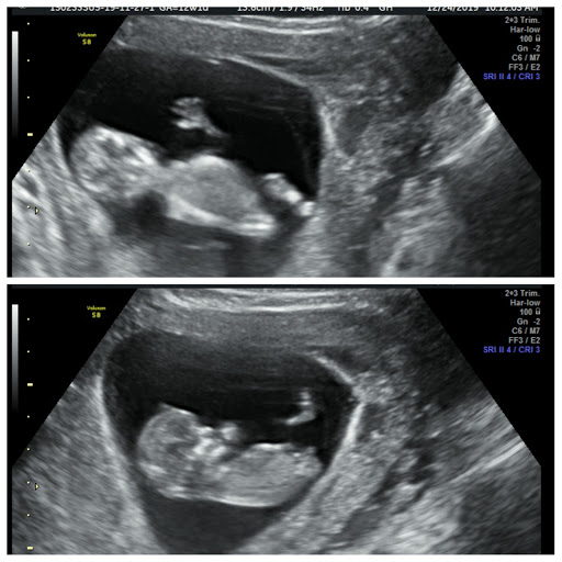 A Little Insight 3D 4D 5D Ultrasound image