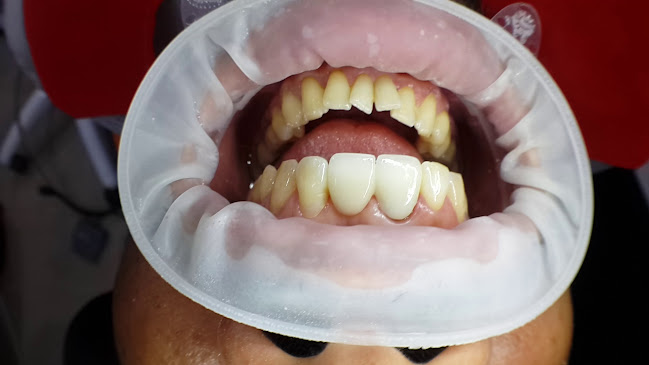 Estética Dental Manta - Dr. Joab Valdivieso Vera / Odontólogo - Dentista