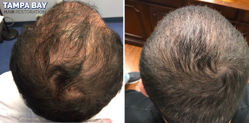 Hair Replacement Service «Tampa Bay Hair Restoration», reviews and photos, 1266 Turner St b, Clearwater, FL 33756, USA