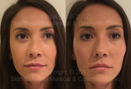 رفع الجلد البلازما - Plasma Skin Lift
