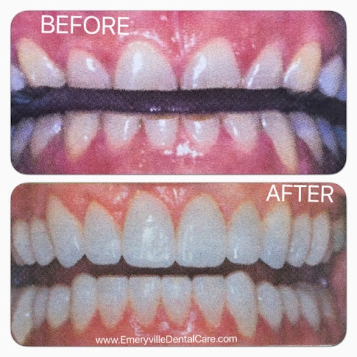Emeryville Dental Care Mini Dental Implant Center image