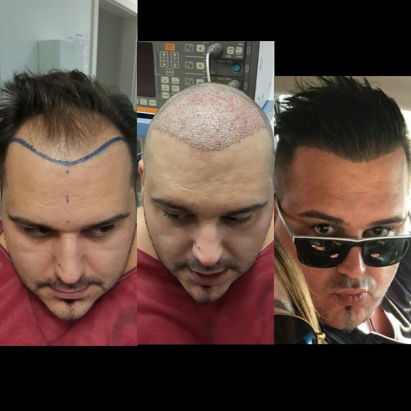 Istanbul Hair Club Haartransplantation Klinik