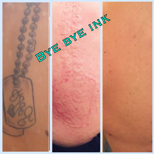 Explore cash tattoo ideas, creative tattoo ideas in Middle Village, available at Bye Bye Ink Laser Tattoo Removal