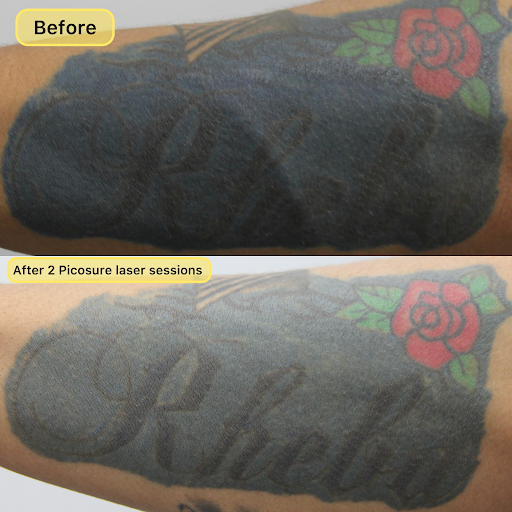 Explore design mac miller tattoo ideas, creative tattoo ideas in New York, available at Ag2g Laser Tattoo Removal & MedSpa