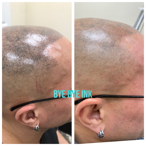 Explore simple adhd tattoo ideas, creative tattoo ideas in Middle Village, available at Bye Bye Ink Laser Tattoo Removal