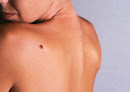 Best Mole Removal Clinics Bournemouth Near You
