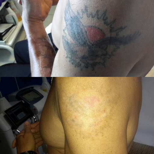 Explore 4 leaf clover tattoo ideas, creative tattoo ideas in Winter Park, available at Winter Park Tattoo Removal