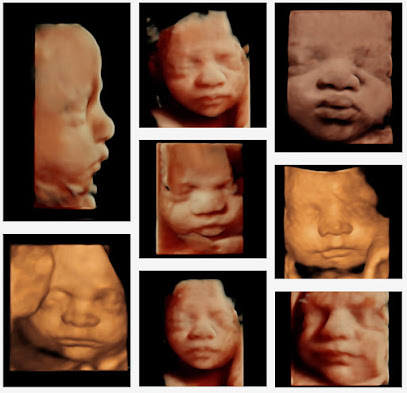 3D 4D Ultrasound by 4D Special Delivery