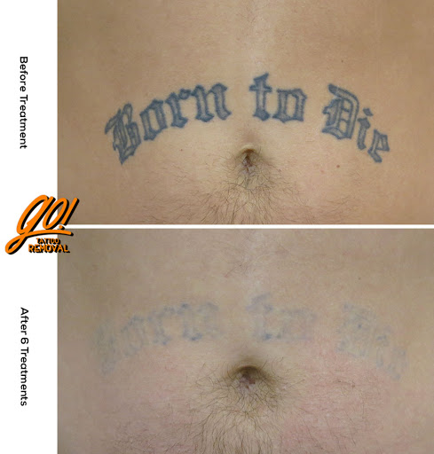 Explore kingdom hearts tattoo ideas, creative tattoo ideas in Allentown, available at Removery Tattoo Removal & Fading