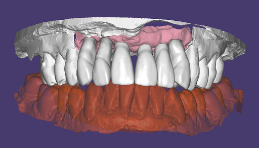 Prótesis dental - Profdent
