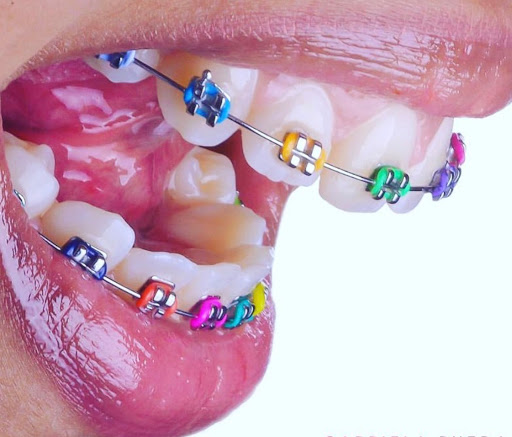 L.A. Dental Braces