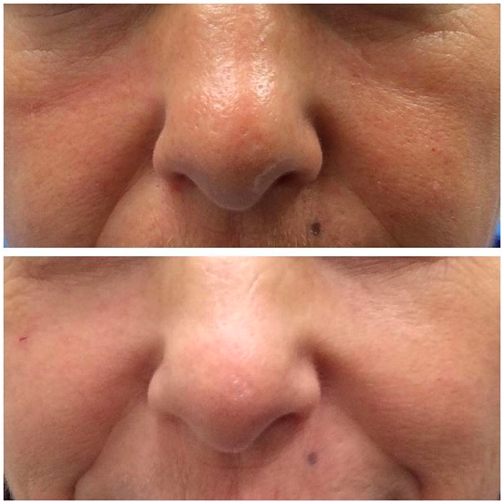 Explore sibling tattoo ideas for 5, creative tattoo ideas in Lake Oswego, available at Lake Oswego Vein and Aesthetic LOVA