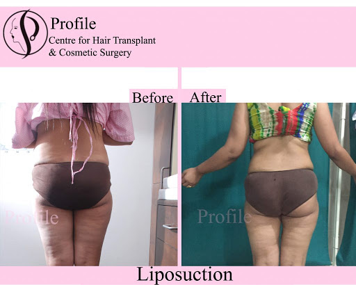 Gynecomastia, Liposuction & Hair Transplant in Ludhiana, Punjab, India