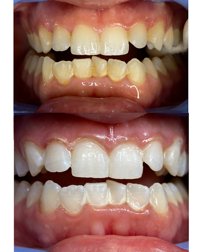 DaVinci Teeth Whitening System RGV