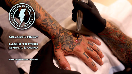 The Tattoo Removal Co