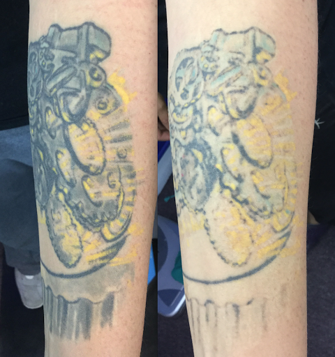 Explore inner elbow tattoo ideas, creative tattoo ideas in Albuquerque, available at ClearWaves Medical Laser Group