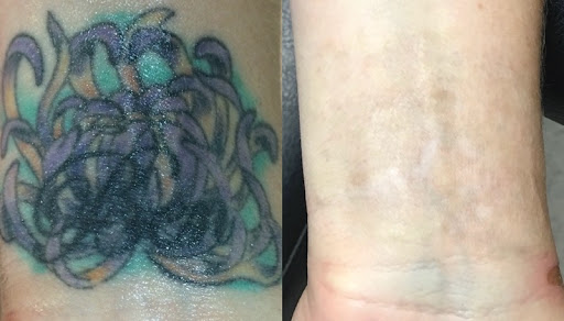 Explore muhammad ali tattoo ideas, creative tattoo ideas in Lawton, available at Clean Canvas Tattoo Removal