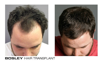 Bosley - Hair Restoration & Transplant