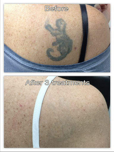 Explore tattoo ideas on forearm for woman, creative tattoo ideas in Honolulu, available at Removery Tattoo Removal & Fading