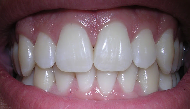 Newcastle Teeth Whitening - Dentist