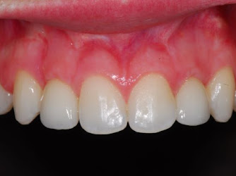 Smile Design - Dental implants Christchurch
