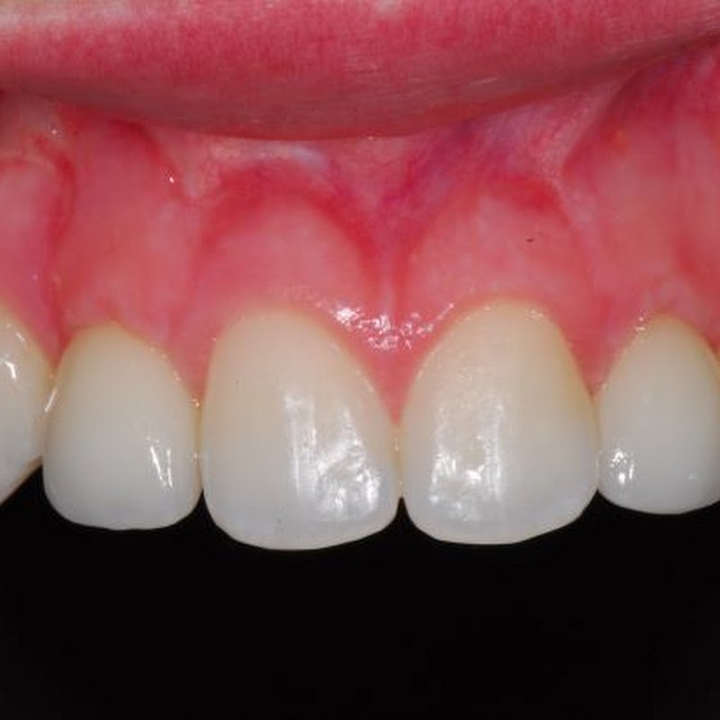 Smile Design - Dental implants Christchurch