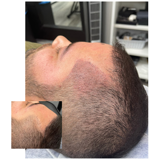 NuHair Ink. Scalp MicroPigmentation & Aesthetic Clinic of Sacramento