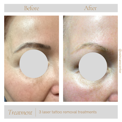 Explore barcode tattoo ideas, creative tattoo ideas in Lima, available at Vein Care Center Laser Specialists