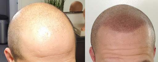 Downey Hair Loss Solutions SMP image
