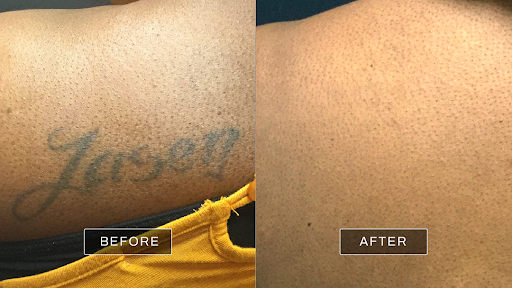 Explore neck name tattoo ideas, creative tattoo ideas in Altamonte Springs, available at Removery Tattoo Removal & Fading