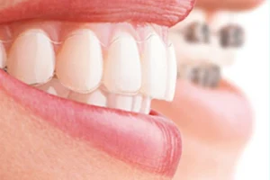 Dr. Khalaf Clinic - 1st Invisalign provider in Lebanon - Orthodontist Sin el Fil , Beirut Lebanon image