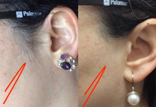 Explore small matching tattoo ideas, creative tattoo ideas in Lake Oswego, available at Lake Oswego Vein and Aesthetic LOVA