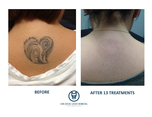 Explore emma tattoo ideas, creative tattoo ideas in San Diego, available at Removery Tattoo Removal & Fading